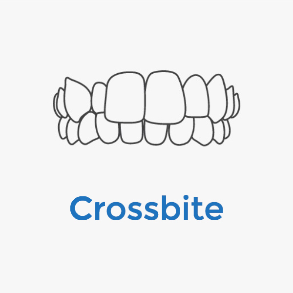 Invisalign-Crossbite