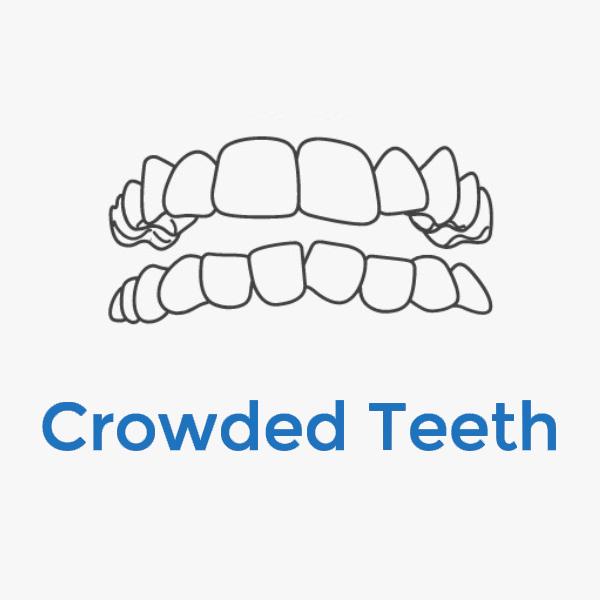 Invisalign-Crowded-Teeth