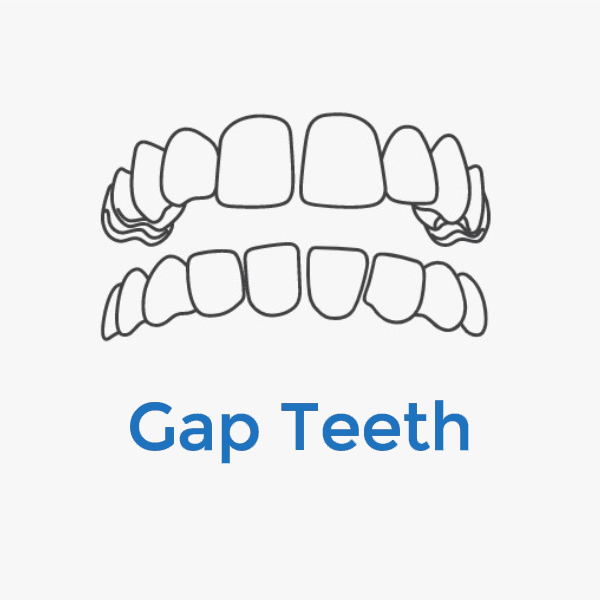 Invisalign-Gap-Teeth