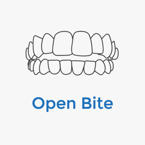 Invisalign-Open-Bite