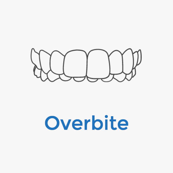 Invisalign-Overbite