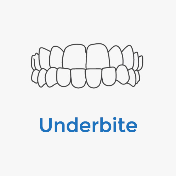 Invisalign-Underbite