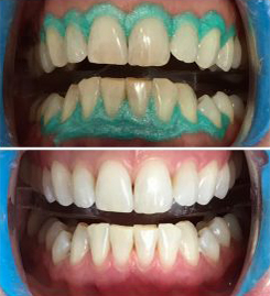 Opalescence Teeth Whitening