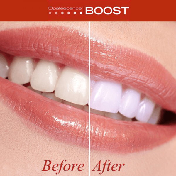 boost-teeth-whitening-600x600