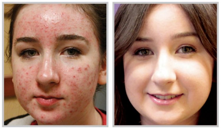 synergy_sciton-bbl-before-after-skin-resurfacing-tightening-acne-treatment